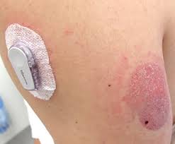 cgm skin irritation 