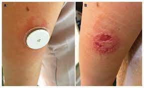 cgm skin irritation 