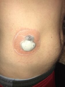 cgm skin irritation medtronic 
