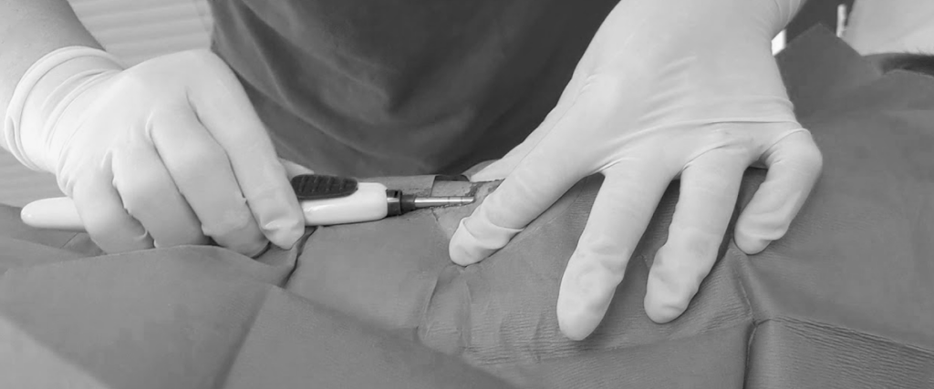 Eversense Implantation Procedure